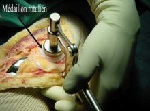 Implant Rotulien